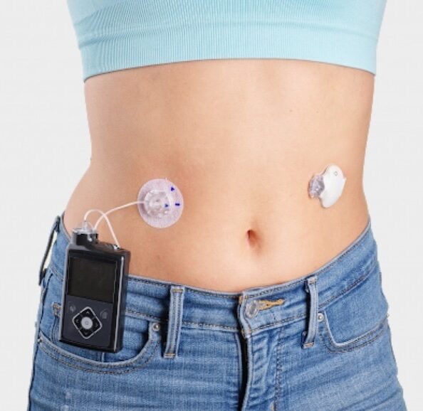 Insulin Pump Therapy